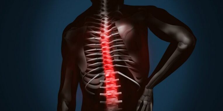 stuburo pažeidimai dėl osteochondrozės